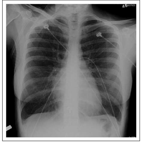 x ray for asthma|What Chest X.